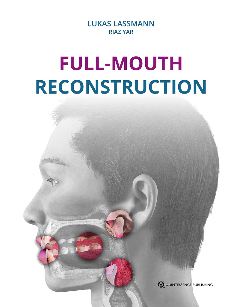 Full-Mouth Reconstruction
