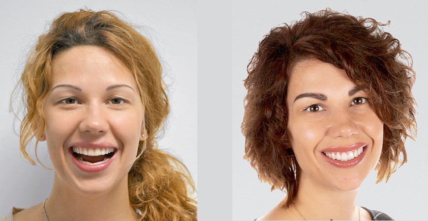 Flujo de trabajo digital para la restauración de una sonrisa