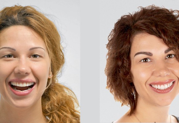 Flujo de trabajo digital para la restauración de una sonrisa