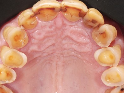 ¿Qué detalles de la adhesión son de interés en los casos de desgaste dentario?