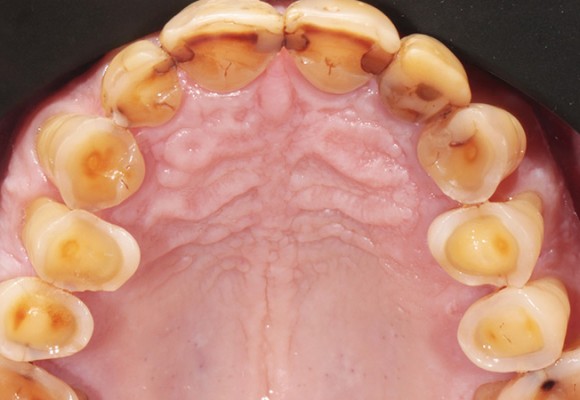 ¿Qué detalles de la adhesión son de interés en los casos de desgaste dentario?