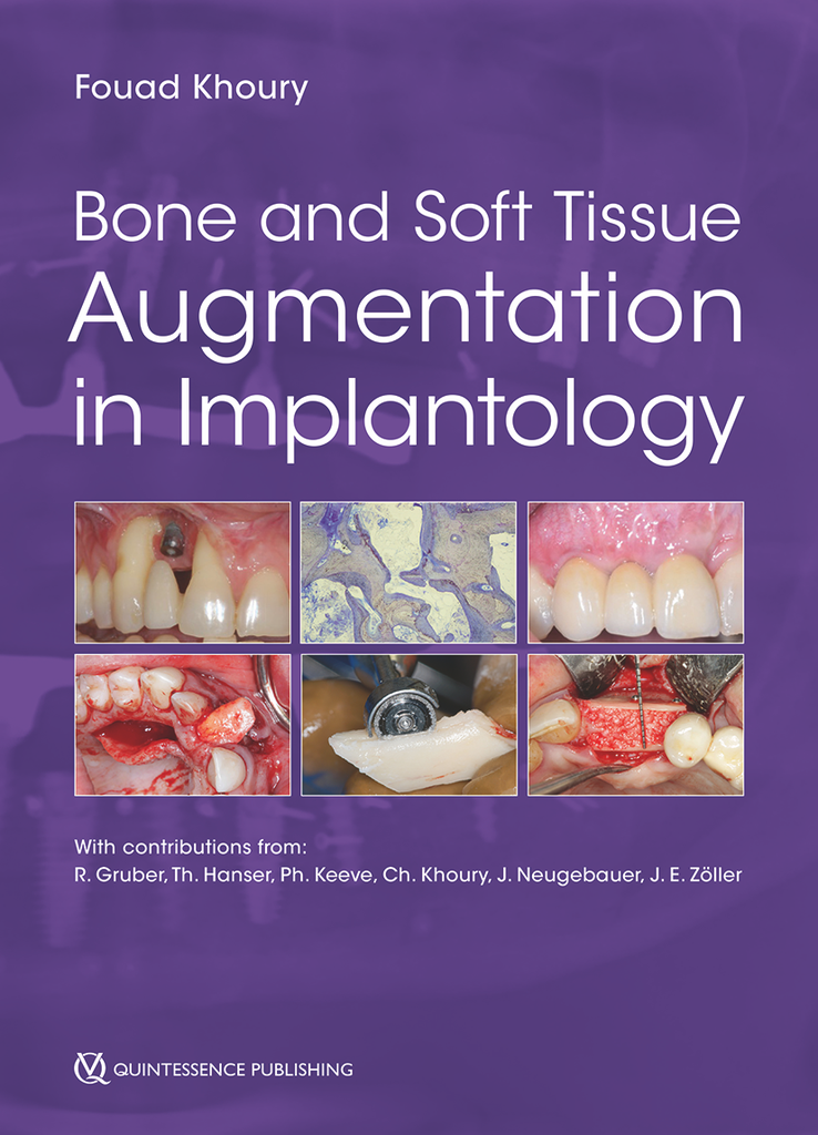 BONE AND SOFT TISSUE AUGMENTATION IN IMPLANTOLOGY