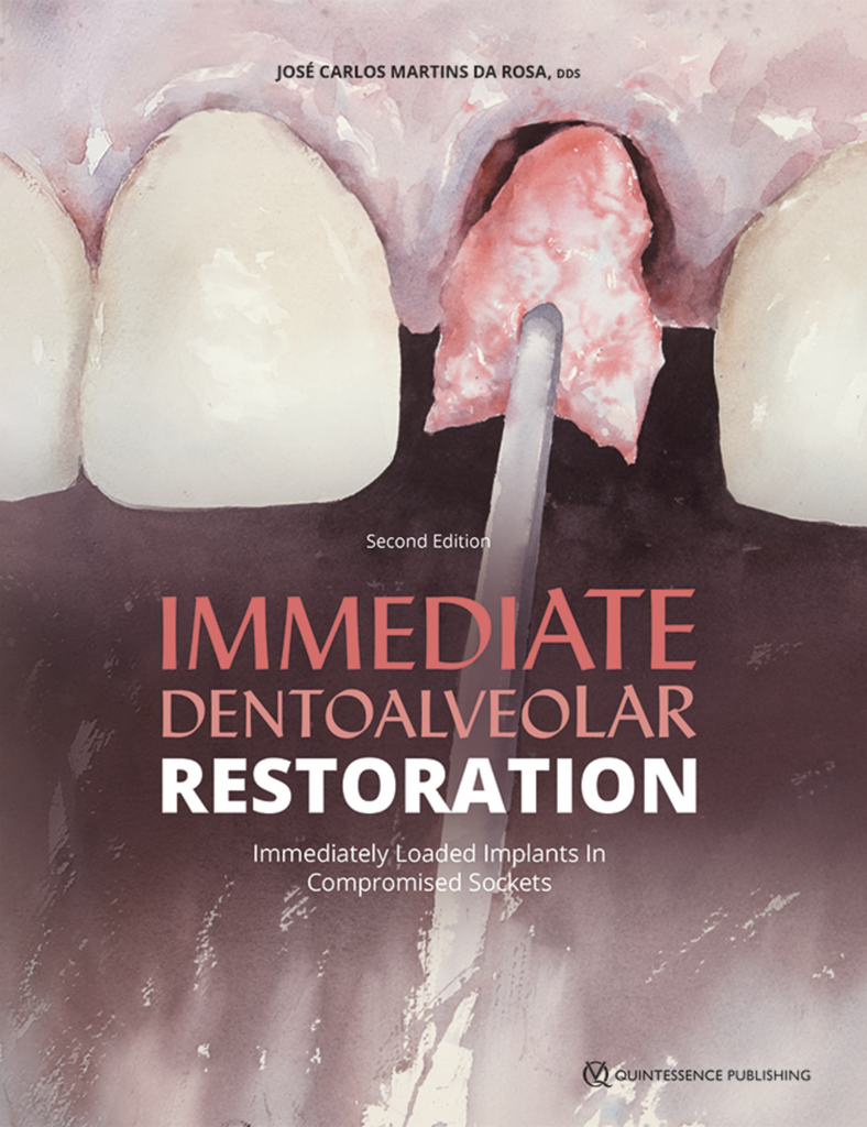 IMMEDIATE DENTOALVEOLAR RESTORATION. Immediately Loaded Implants in Compromised Sockets