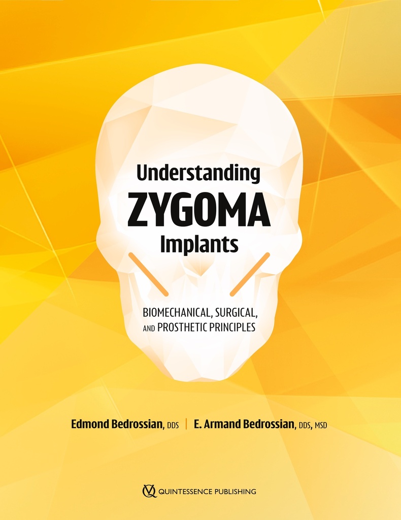 Understanding Zygoma Implants Biomechanical, Surgical, and Prosthetic Principles