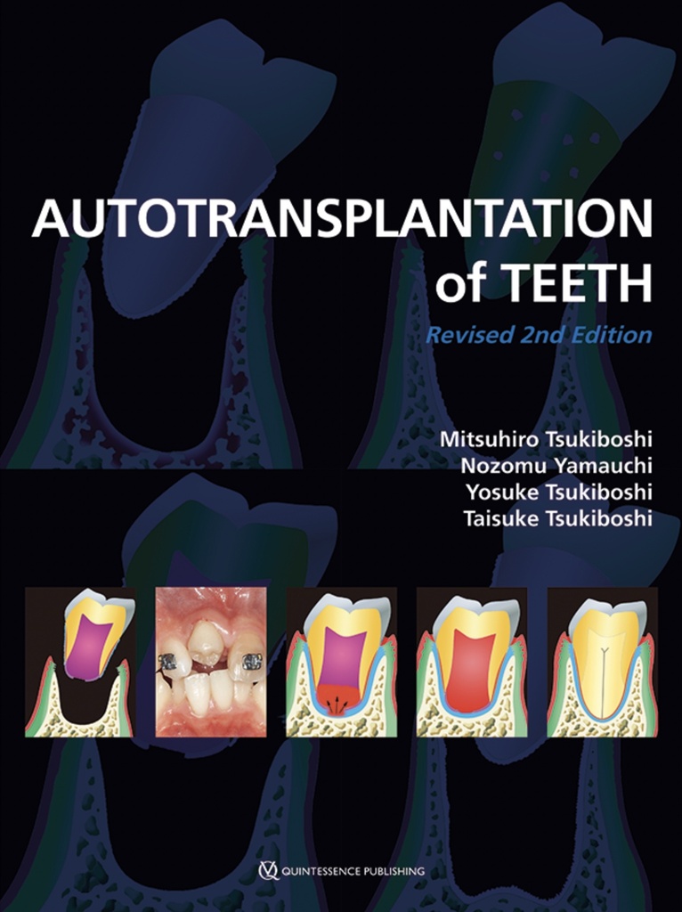 Autotransplantation of Teeth