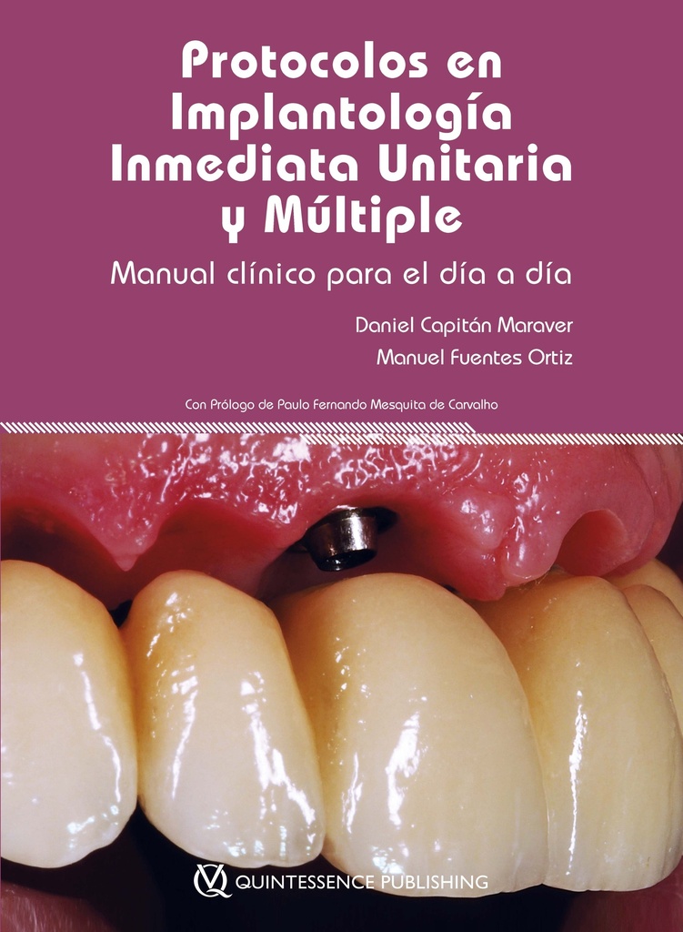 Protocolos en Implantología Inmediata Unitaria y Múltiple. Manual Clínico para el día a día