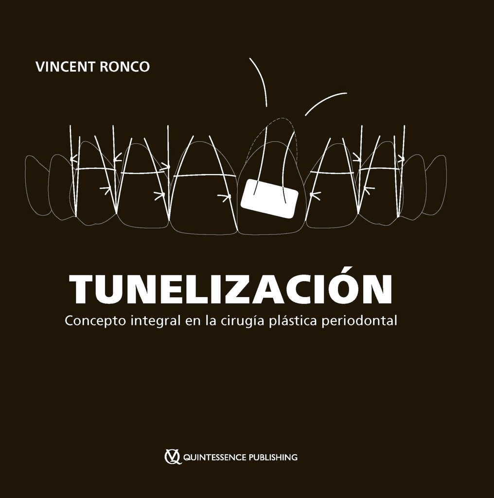 TUNELIZACIÓN. Concepto integral en la cirugía plástica periodontal