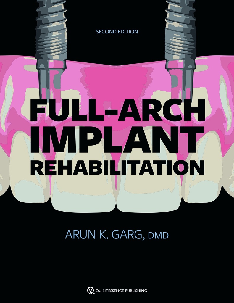 Full-Arch Implant Rehabilitation