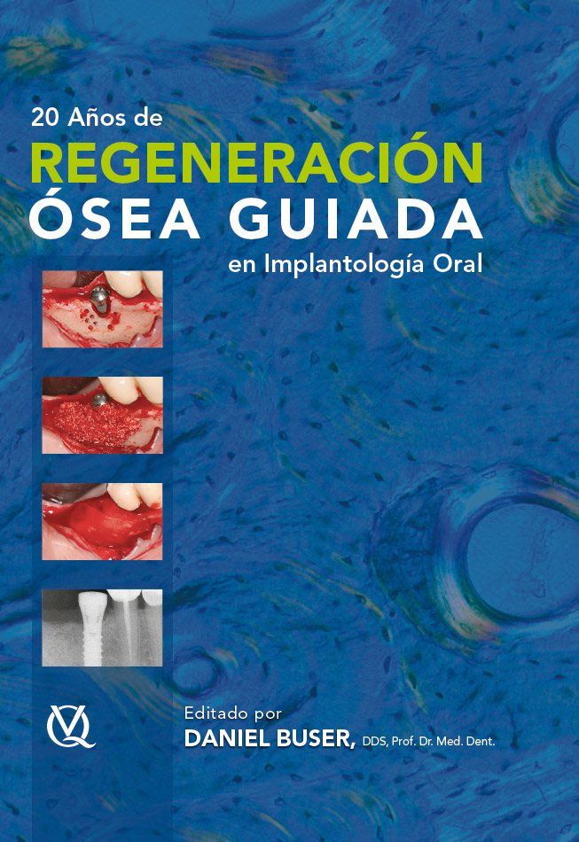 20 AÑOS DE REGENERACIÓN ÓSEA GUIADA EN IMPLANTOLOGÍA, SEGUNDA EDICIÓN