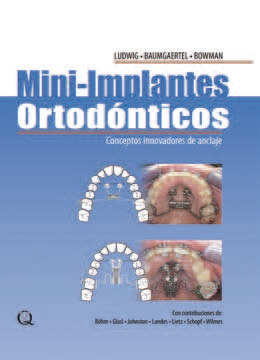 MINI-IMPLANTES ORTODONCICOS (DIGITAL)
