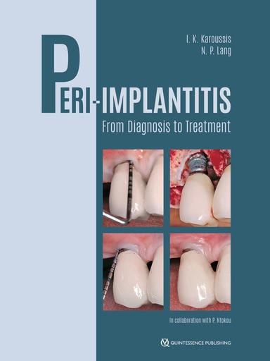 [978-1-78698-145-5] Peri-Implantitis From Diagnosis to Treatment